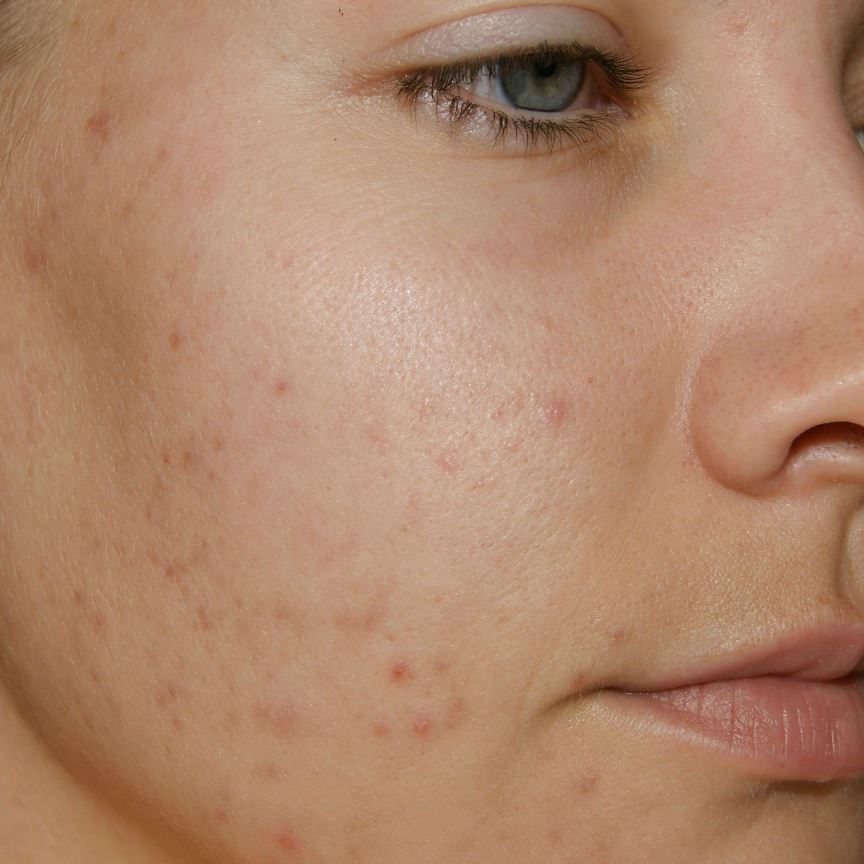 Facial hair labia acne period
