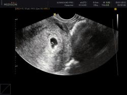 Fetální ultrazvuk v týdnu 5