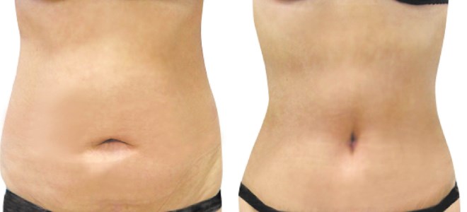 abdominoplastyka zdjęcia przed i po 1