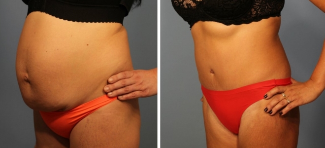 abdominoplastične fotografije pred in po 2
