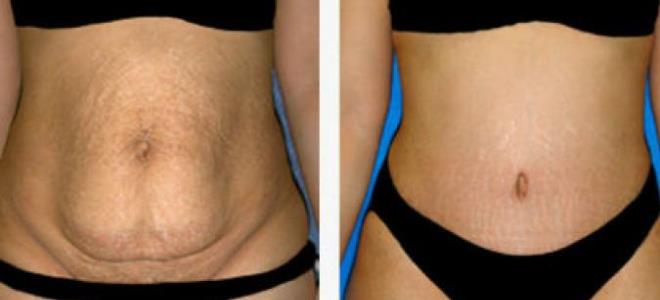 abdominoplastyka zdjęcia przed i po 3