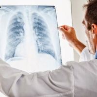 diagnoza pljučnega abscesa