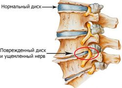 bolečine v spodnjem delu vratu