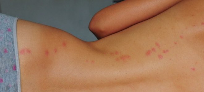 akné na kůži