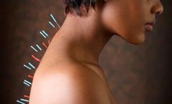 akupunktura dla osteochondrozy szyjnej