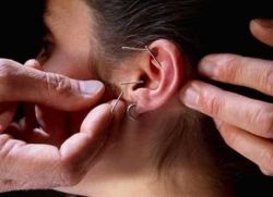 akupunktura w uchu dla utraty wagi