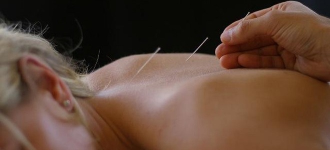 koristi in škode akupunkture2