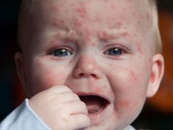 Acyclovir v případě kuřat neštovic v dávce dětí