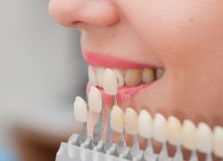 фазе естетске рестаурације зуба