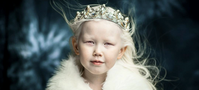 болезнь альбинизм