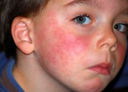 alergijski dermatitis pri otrocih