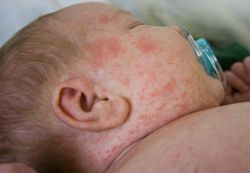 alergiczna wysypka u dziecka
