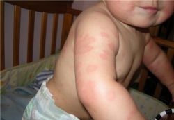 алергичен обрив при симптомите на децата