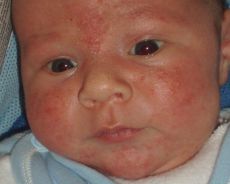 alergija pri dojenčkih, kako zdraviti
