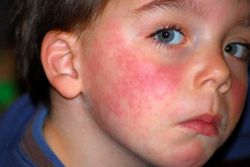 alergije na otroka, kako zdraviti