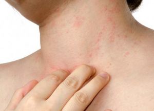 alergická vyrážka na těle 1