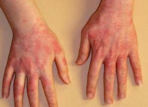 alergická vyrážka na těle 2
