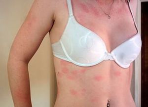 алергијски осип на телу 4