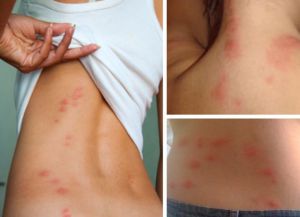алергијски осип на телу 6