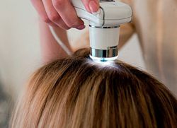 jak leczyć łysienie u kobiet