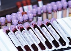 Krvni test je povečal amilazo