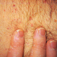 амилоидоза на кожата