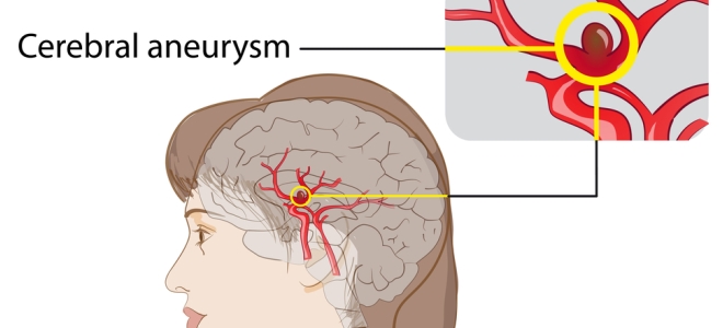 příznaky aneuryzmatu mozkových cév