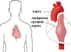 aneuryzma hrudní aorty