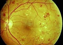 ангиопатија ретина симптома ока