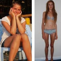 анорексия преди и след 5