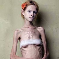 anorexie u dospívajících