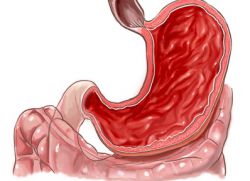 erozivni antralni gastritis