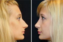 odstranění nosu na nosu