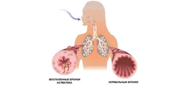 бронхиальная астма у ребенка