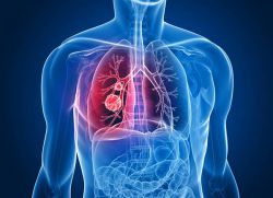 bronhitis s astmatično komponento