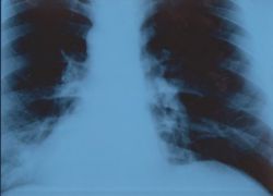 atelectáza plicního rentgenu