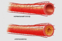 simptom ateroskleroze koronarne arterije