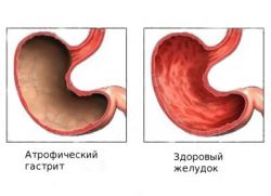 Atrofija želodčne sluznice