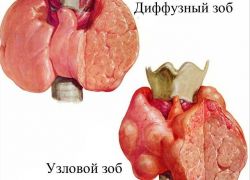 avtoimunska difuzna oblika tiroiditisa