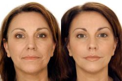 биоревитализиране на лицето с хиалуронова киселина