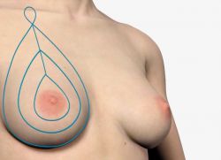 гърдите се повдигат с аптос нишки