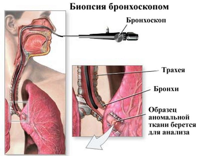бронхоскопия с биопсией