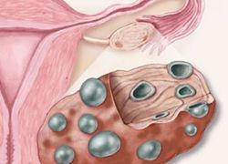 způsoby léčby polycystických vaječníků