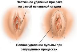 zdravljenje vulvarnega raka