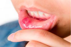 objawy kandydozy w jamie ustnej