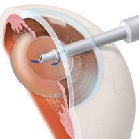 катаракта хирургия