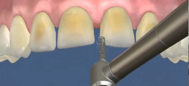 обръщане на зъба под керамичен фурнир