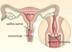 analiza biopsije vrata maternice