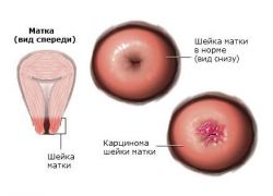adenokarcinomu děložního čípku