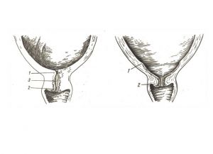 Razširitev materničnega vratu na 1 prst 1
